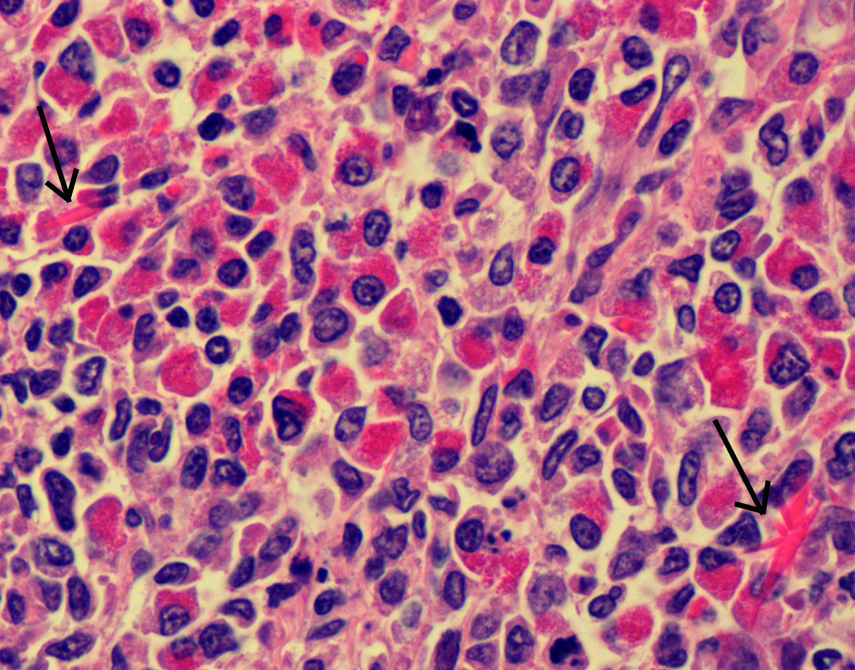 Image 4, paraspinal mass with Charcot-Leyden crystals (arrows)